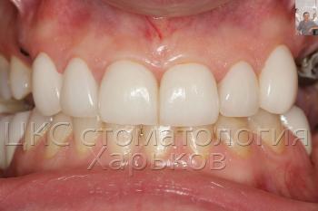 Beautiful smile AFTER treatment