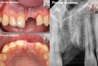 Аугментация - наращивание кости челюсти