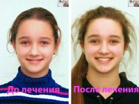 Брекеты прелесть