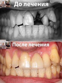 Экспресс имплантация, клинический случай в ЦКС