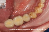Экспресс имплантация и двухэтапная имплантация