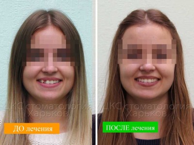 Лечение кривых зубов. Керамические и металлические брекеты в действии