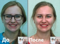 У Вас кривые зубы? Выбирайте брекеты!