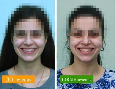 Лечение брекетами в Харькове