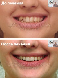 Лечение брекетами взрослых пациентов в Харькове