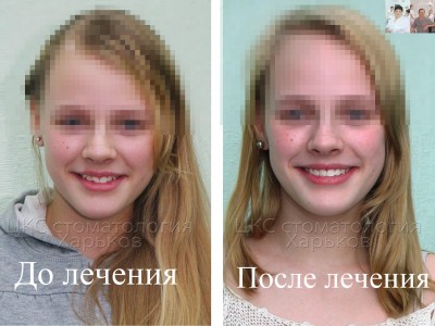 Лечение брекетами зубов после травмы