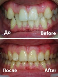 Обратное перекрытие зубов. Лечение брекетами в ЦКС стоматология Харьков