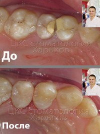 Правильные пломбы