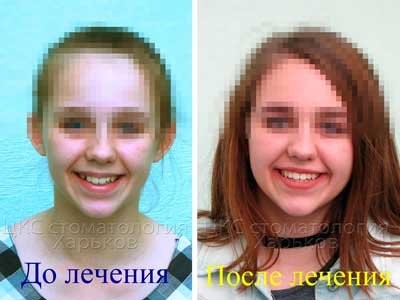 Ретинированный зуб. Лечение керамическими брекетами в ЦКС