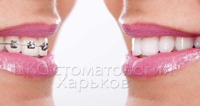 Стоит ли удалять зубы при дистальном прикусе?