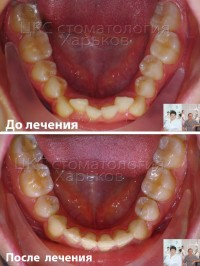 Устанавливать брекеты на одну челюсть - это неправильно!