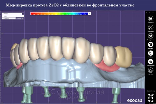 Фото проведения цифрового дизайна протеза на имплататах