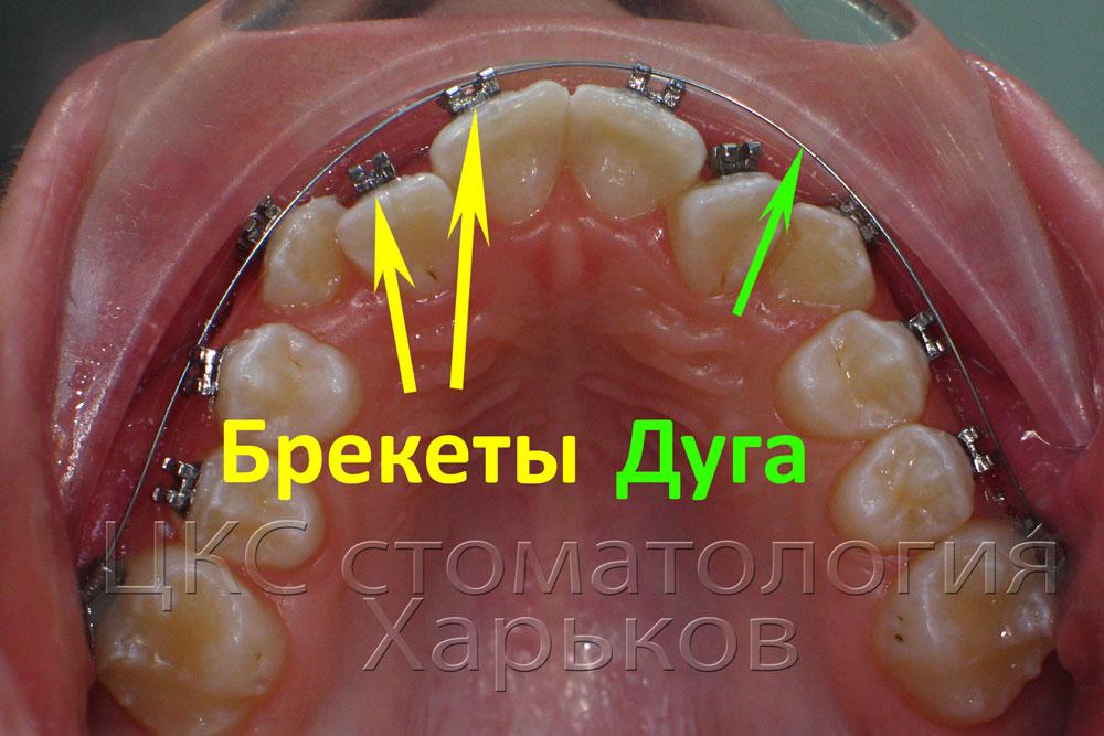 Orthodontic arc aligns the teeth in three planes