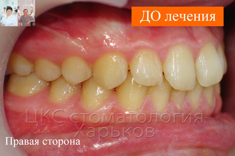 Прикус ДО лечения