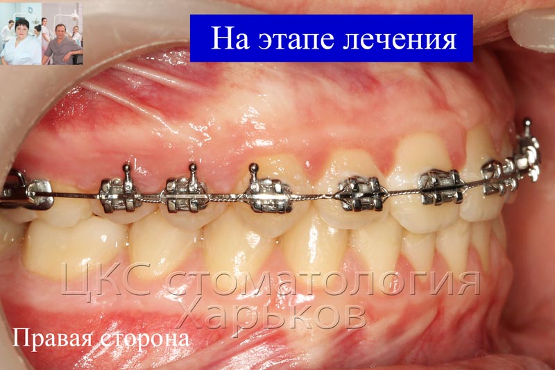 На этапе ортодонтического лечения, вид справа