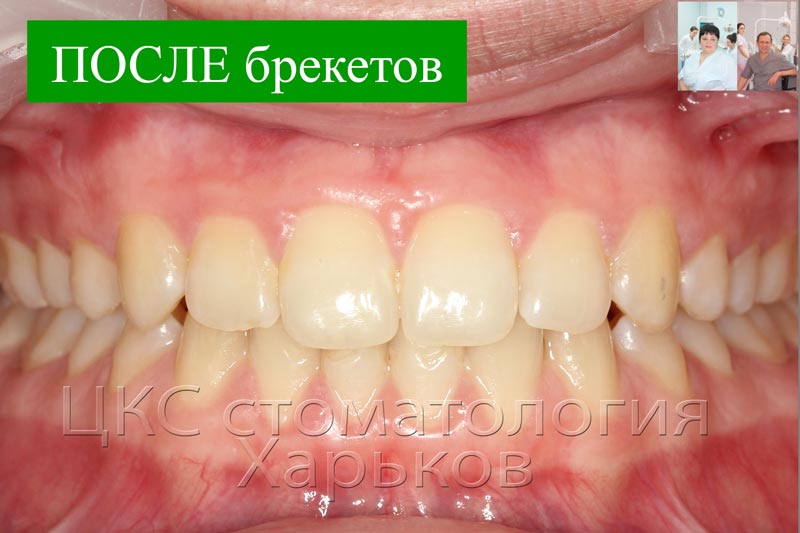 ПОСЛЕ брекетов