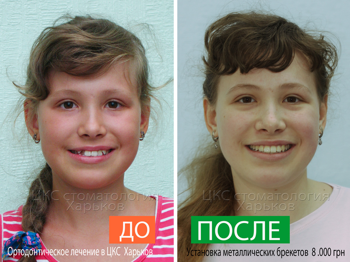 Улыбка пациента ДО и ПОСЛЕ лечения брекетами