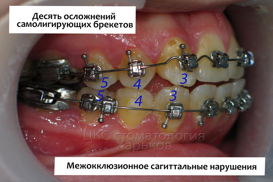 Нарушение прикуса в сагиттальном направлении