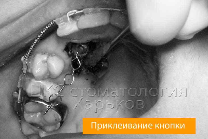 ход стоматологической операции