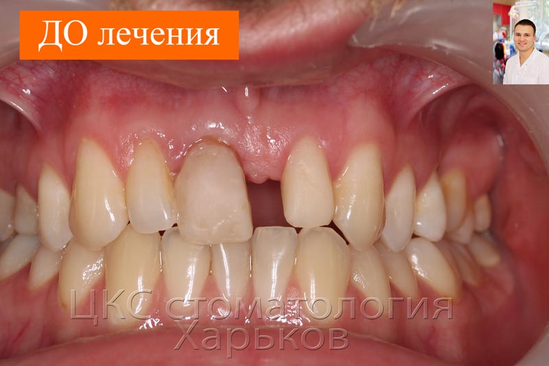 ДО протезирования