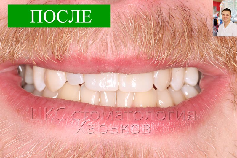 Улыбка харьковчанина после лечения