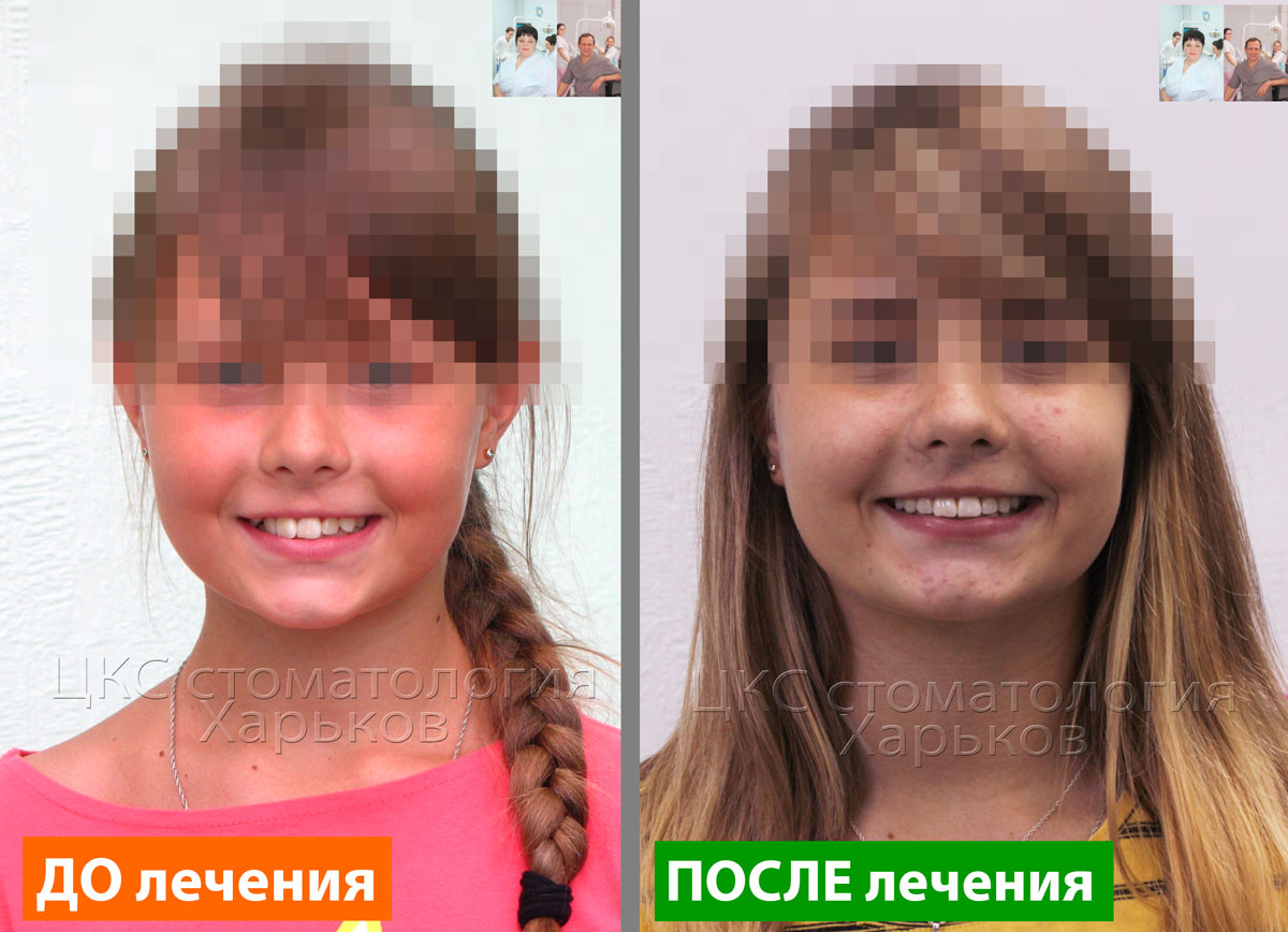 Улыбка полученная благодаря работе ортодонта