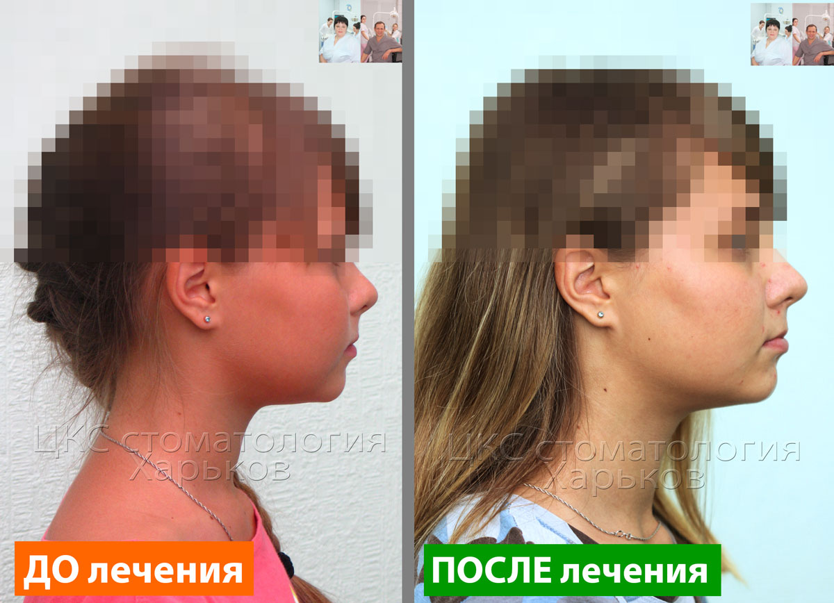 Форма лица ДО и ПОСЛЕ