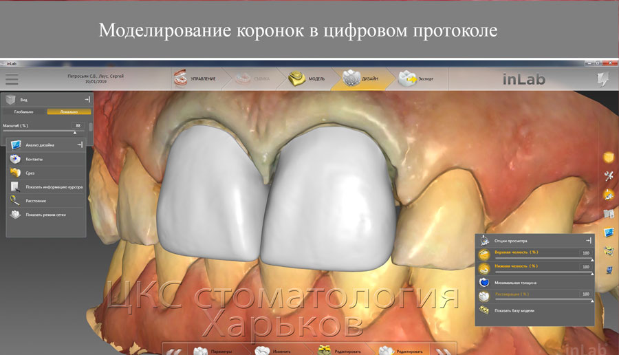 Этап изготовления коронок