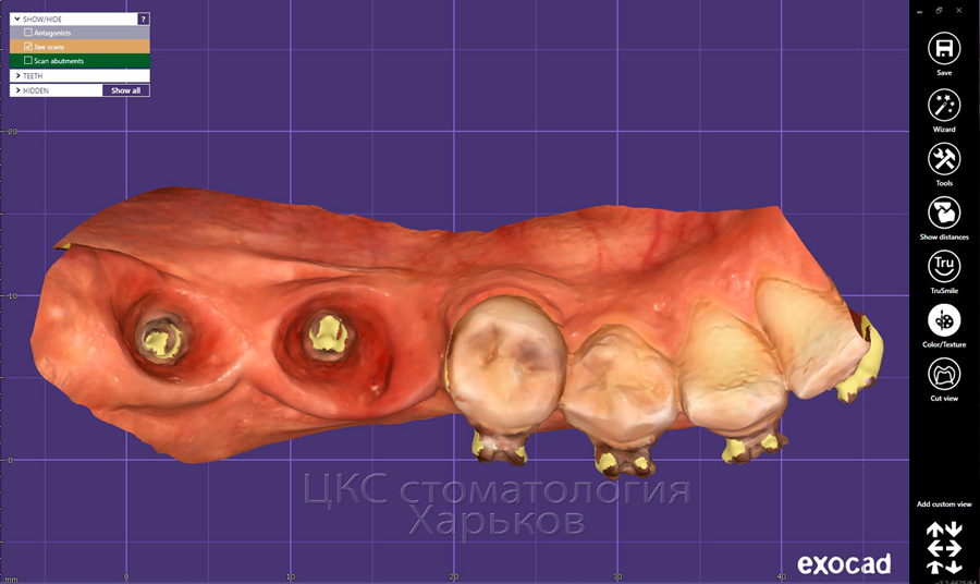 цифровой скан челюсти