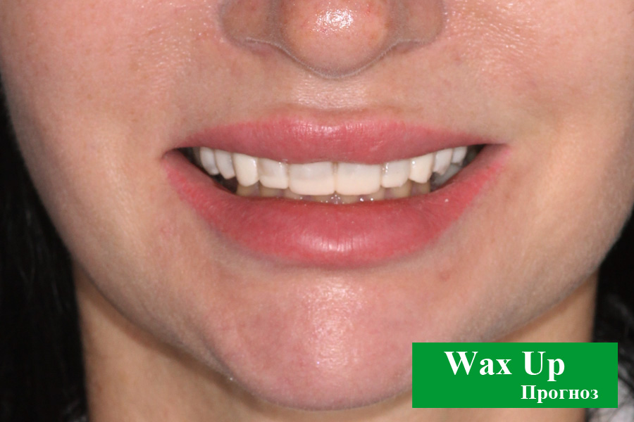 Фото улыбки с wax up