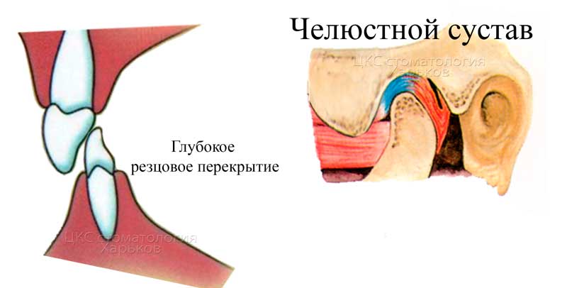 глубокое резцовое перекрытие