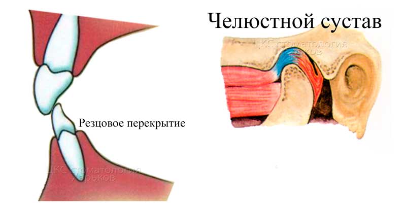 нормальное резцовое перекрытие