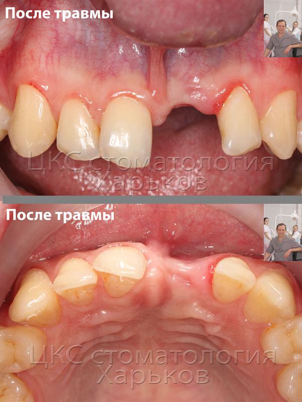 На фото признаки малого объема кости