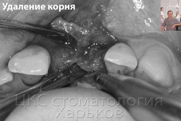 Фото сделано в момент удаления корня зуба