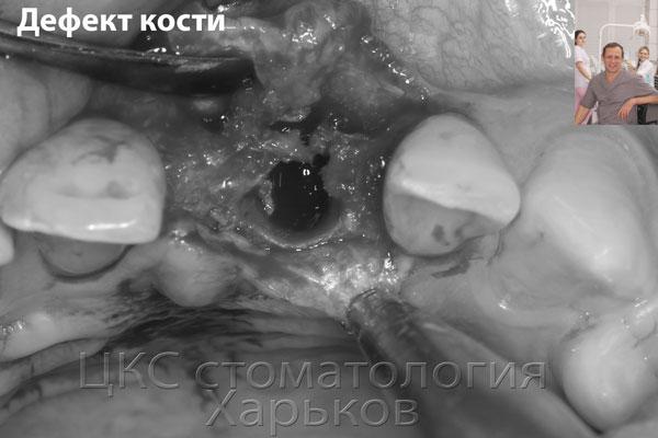 На фото дефект вестибулярной костной стенки альвеолы