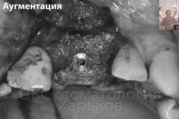 Аугментация, наращивание кости зуба