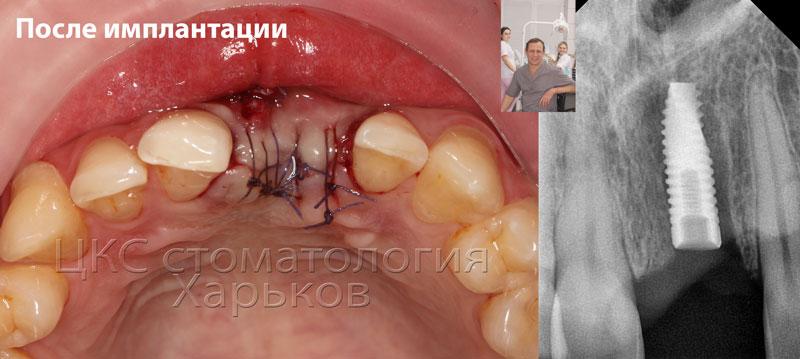 Фото после операции имплантации