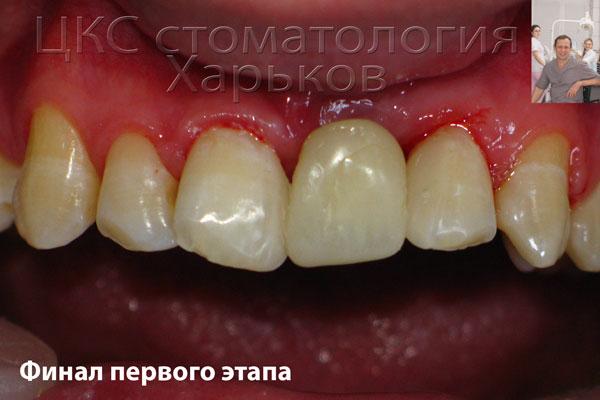 Первый этап зубной имплантации