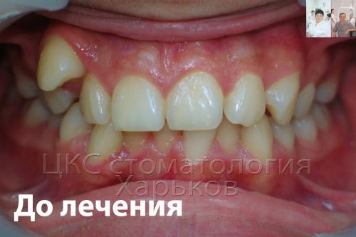Неровные зубы до лечения металлическими брекетами