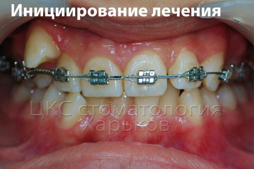 Установка брекетов сначала на одну челюсть облегчает адаптацию к металлическим брекетам