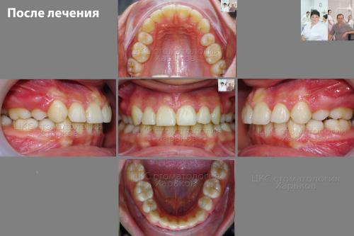 Прикус пациента после лечения металлическими брекетами