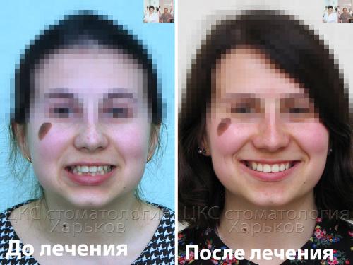После лечения металлическими брекетами улыбка пациента стала красивой