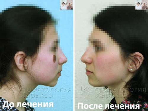 Профиль  до и после лечения металлическими брекетами