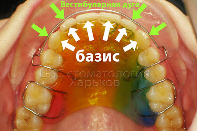Съемный пластиночный reteyner