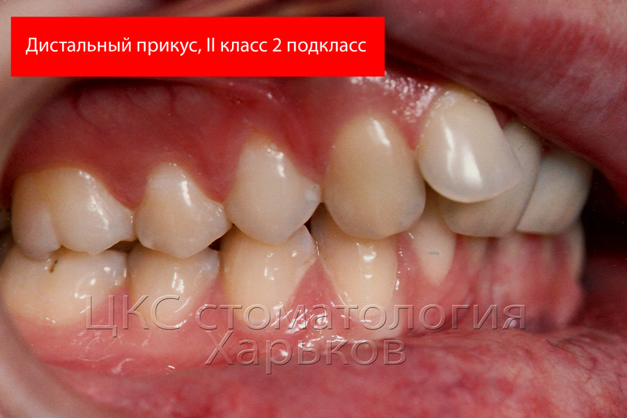 классификации энгля ii класс 2 подкласс