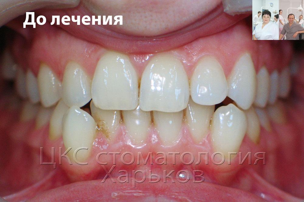 Неровные зубы до лечения керамическими брекетами