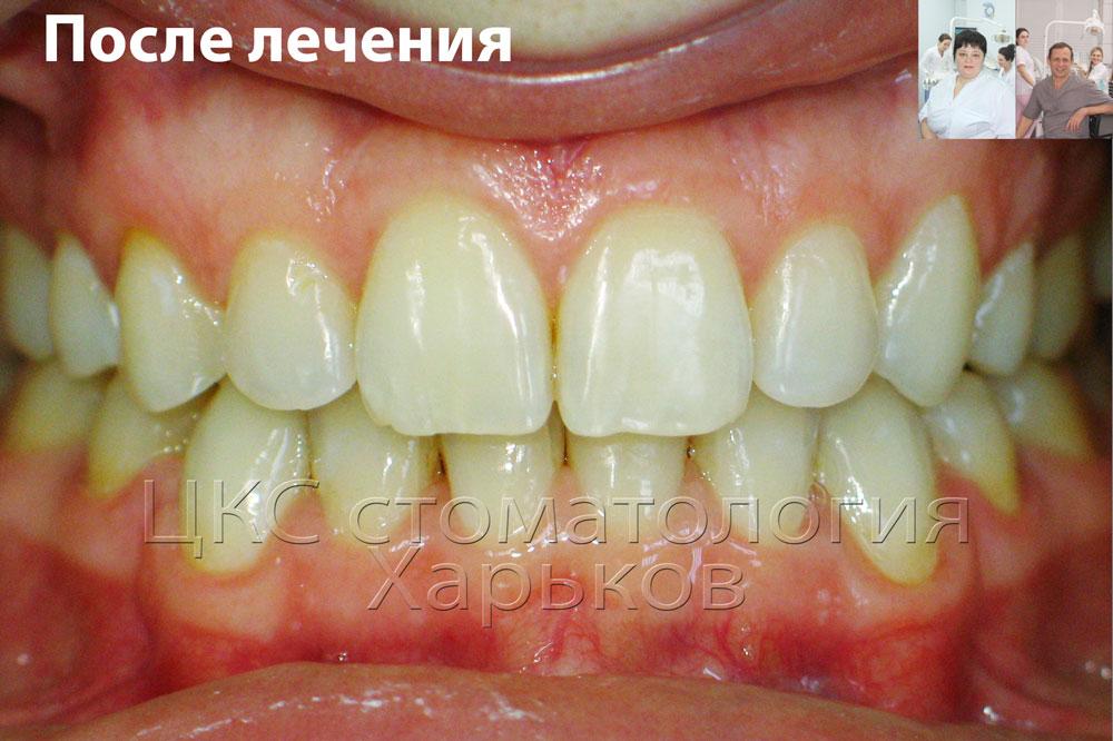 Улыбка пациента после лечения керамическими брекетами