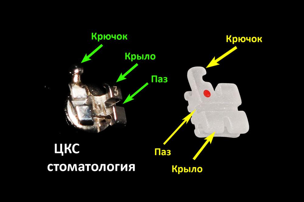 конструктивные особенности металлического и керамического брекетов