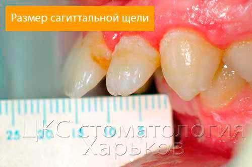 Фото измерения сагиттальной щели