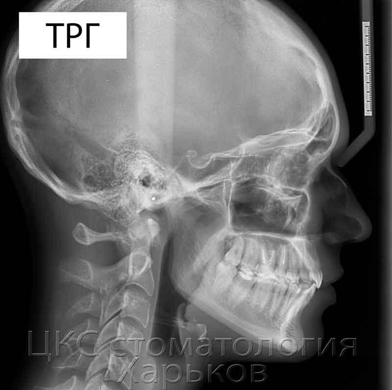 ТРГ рентгеновский снимок